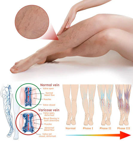 Herbal Varicose Veins Spray, 50ml