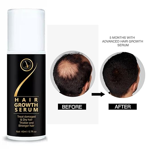 Hair Growth Serum (Roll On) | Treat Damaged & Dry hair into Thicker and Stronger
